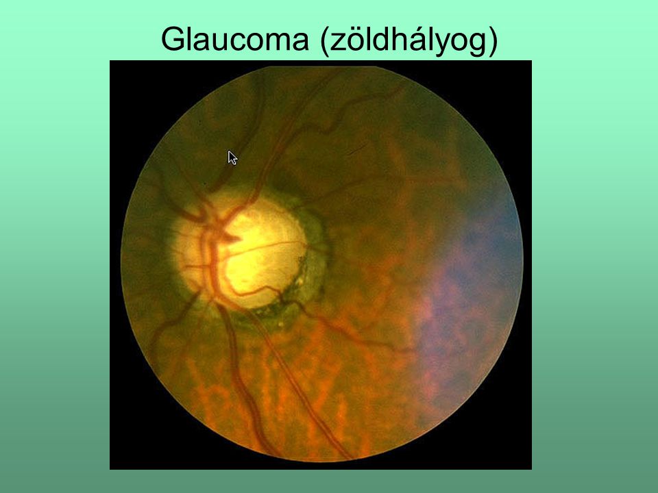 Glaucoma (zöldhályog)