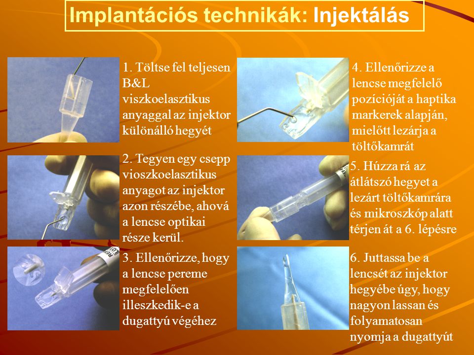 Implantációs technikák: Injektálás