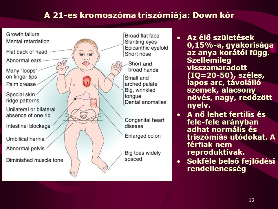A 21-es kromoszóma triszómiája: Down kór