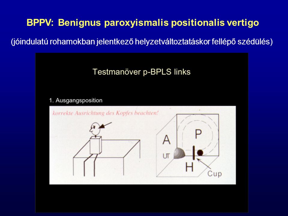 BPPV: Benignus paroxyismalis positionalis vertigo