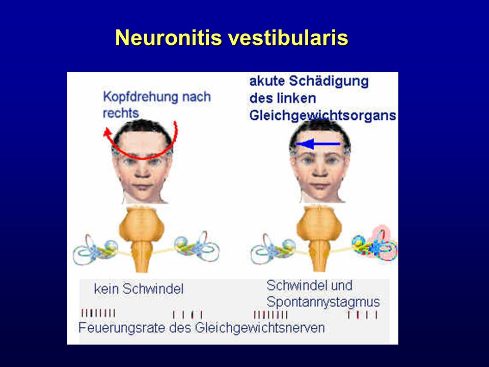 Neuronitis vestibularis