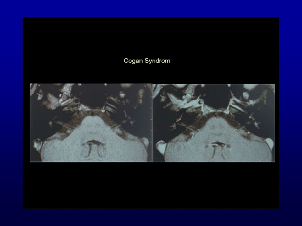 Cogan Syndroma = autoimmunmegbetegedés interstitialis keratitis, audio-vestibularis symptomák.