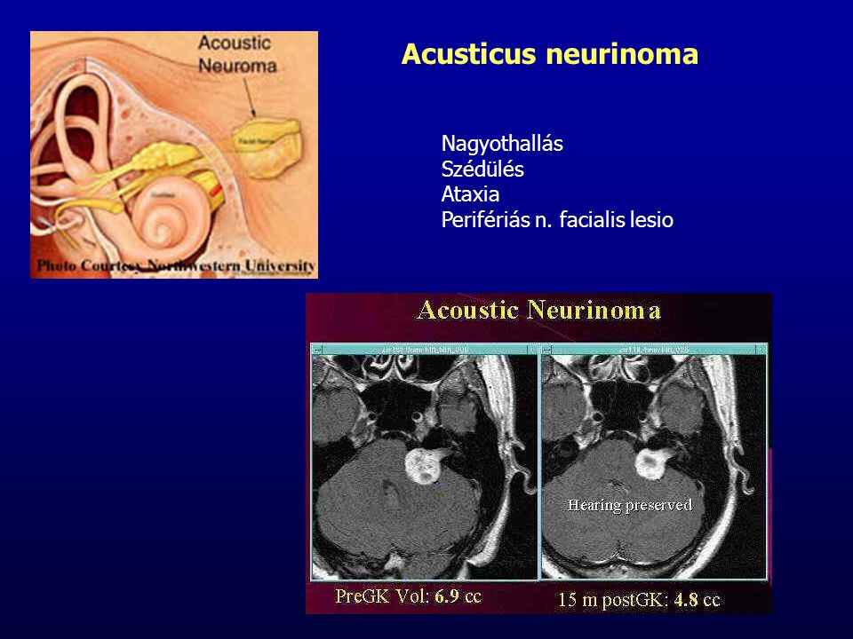 Acusticus neurinoma Nagyothallás Szédülés Ataxia