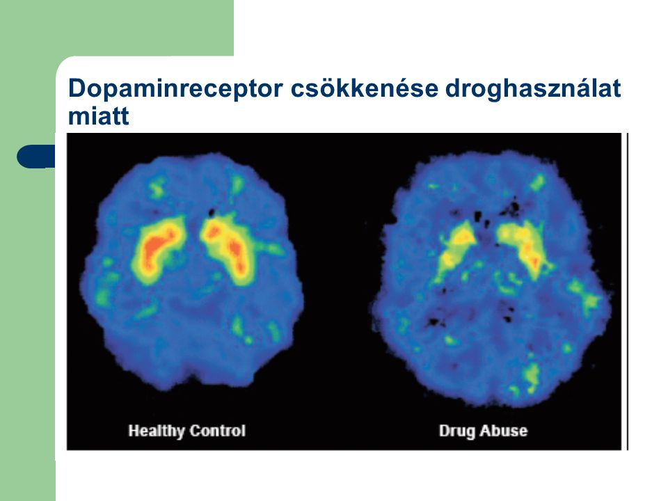 Dopaminreceptor csökkenése droghasználat miatt