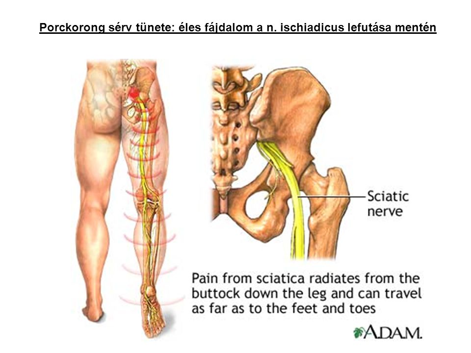 Porckorong sérv tünete: éles fájdalom a n. ischiadicus lefutása mentén