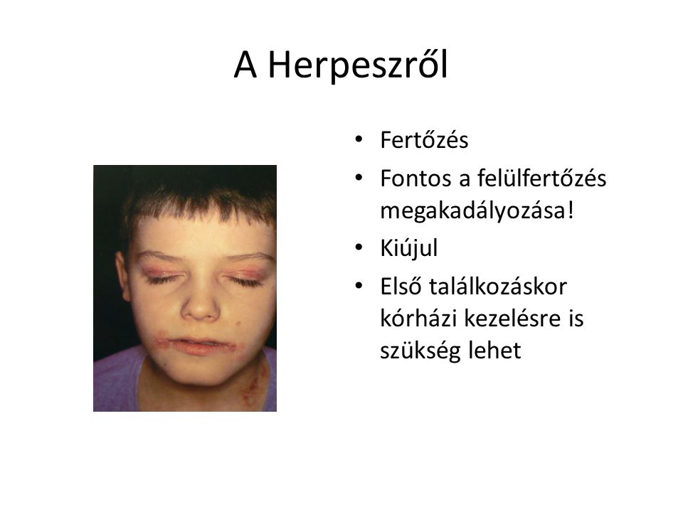 A Herpeszről Fertőzés Fontos a felülfertőzés megakadályozása! Kiújul