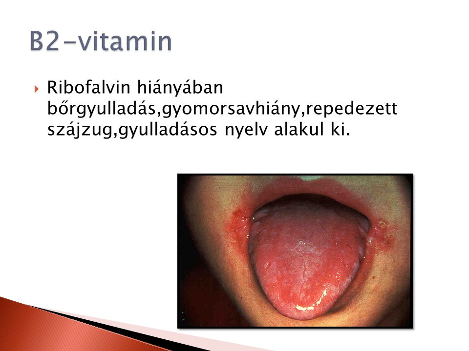 B2-vitamin Ribofalvin hiányában bőrgyulladás,gyomorsavhiány,repedezett szájzug,gyulladásos nyelv alakul ki.