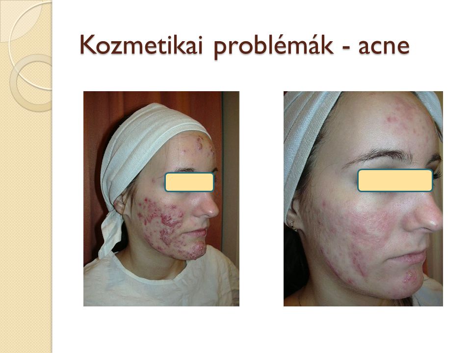 Kozmetikai problémák - acne