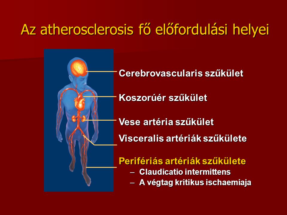 Az atherosclerosis fő előfordulási helyei