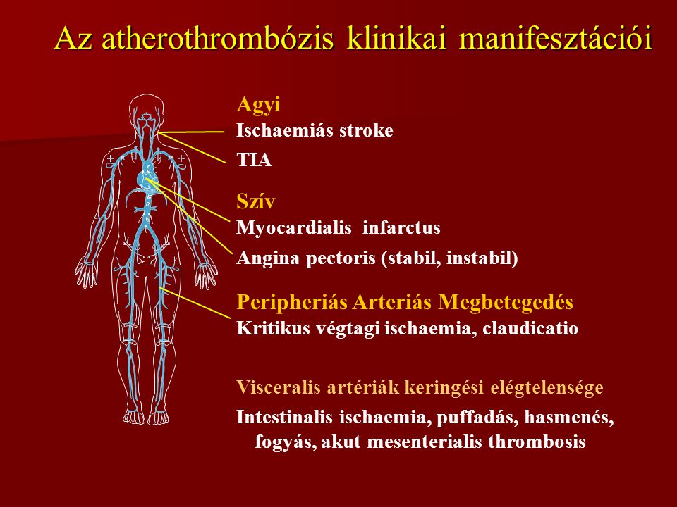 Az atherothrombózis klinikai manifesztációi