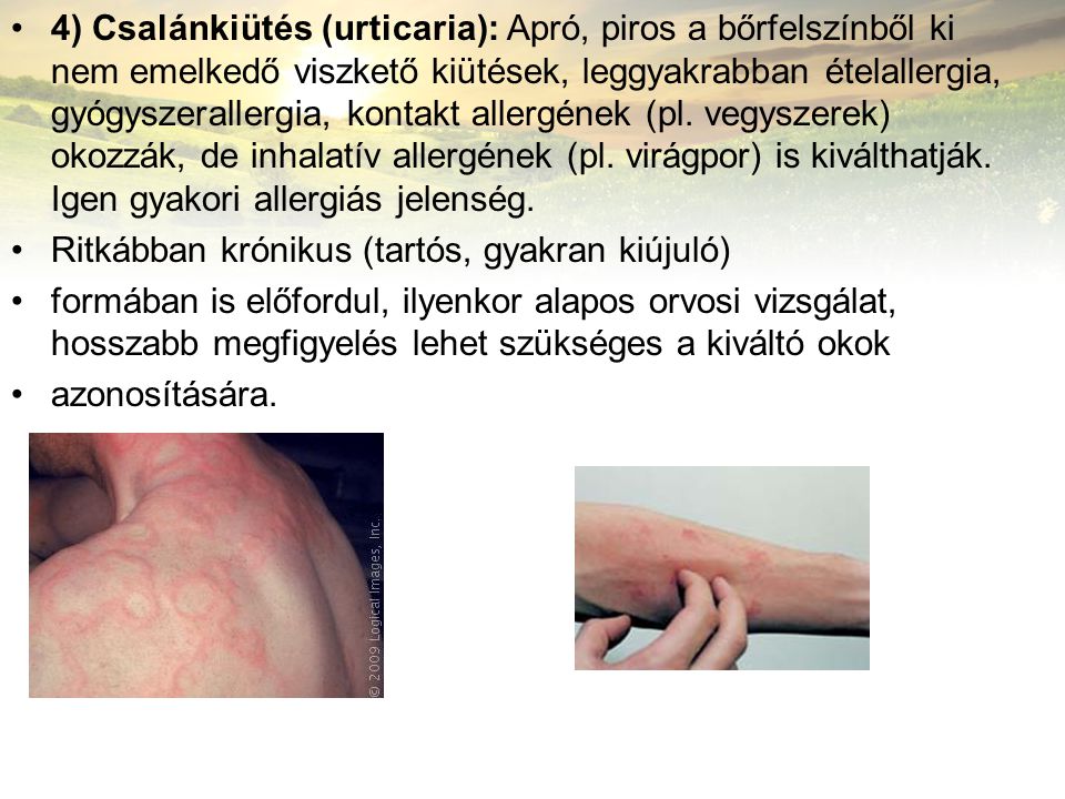 4) Csalánkiütés (urticaria): Apró, piros a bőrfelszínből ki nem emelkedő viszkető kiütések, leggyakrabban ételallergia, gyógyszerallergia, kontakt allergének (pl. vegyszerek) okozzák, de inhalatív allergének (pl. virágpor) is kiválthatják. Igen gyakori allergiás jelenség.