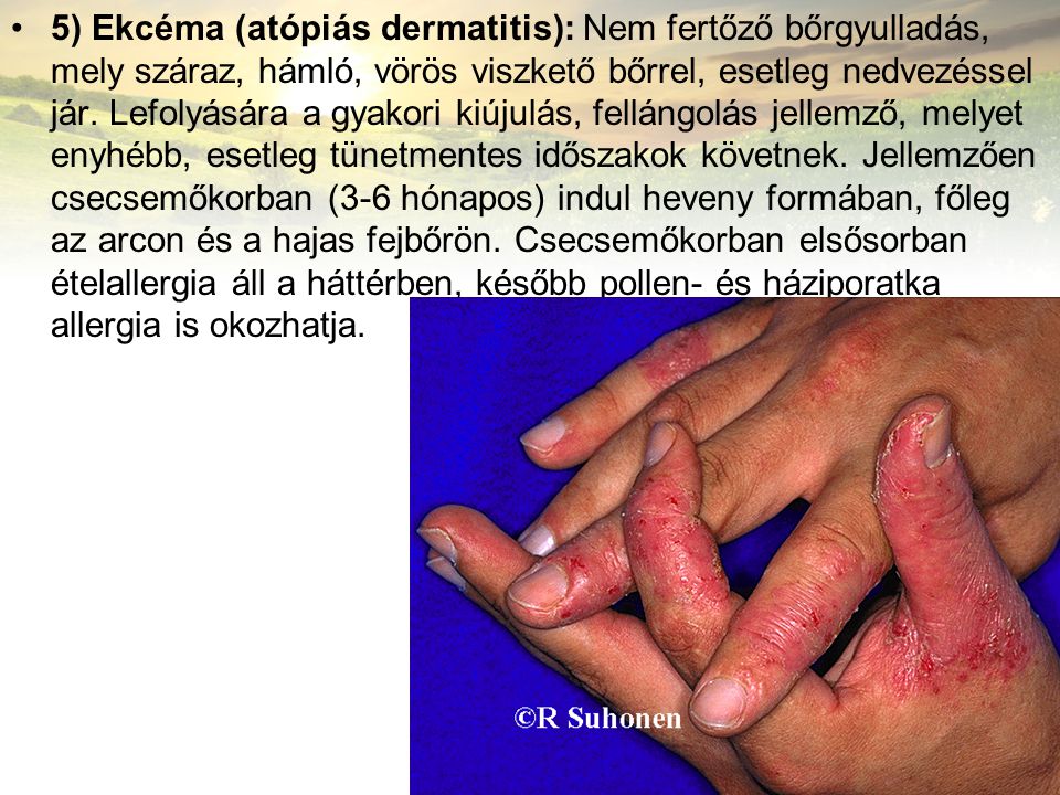 5) Ekcéma (atópiás dermatitis): Nem fertőző bőrgyulladás, mely száraz, hámló, vörös viszkető bőrrel, esetleg nedvezéssel jár.