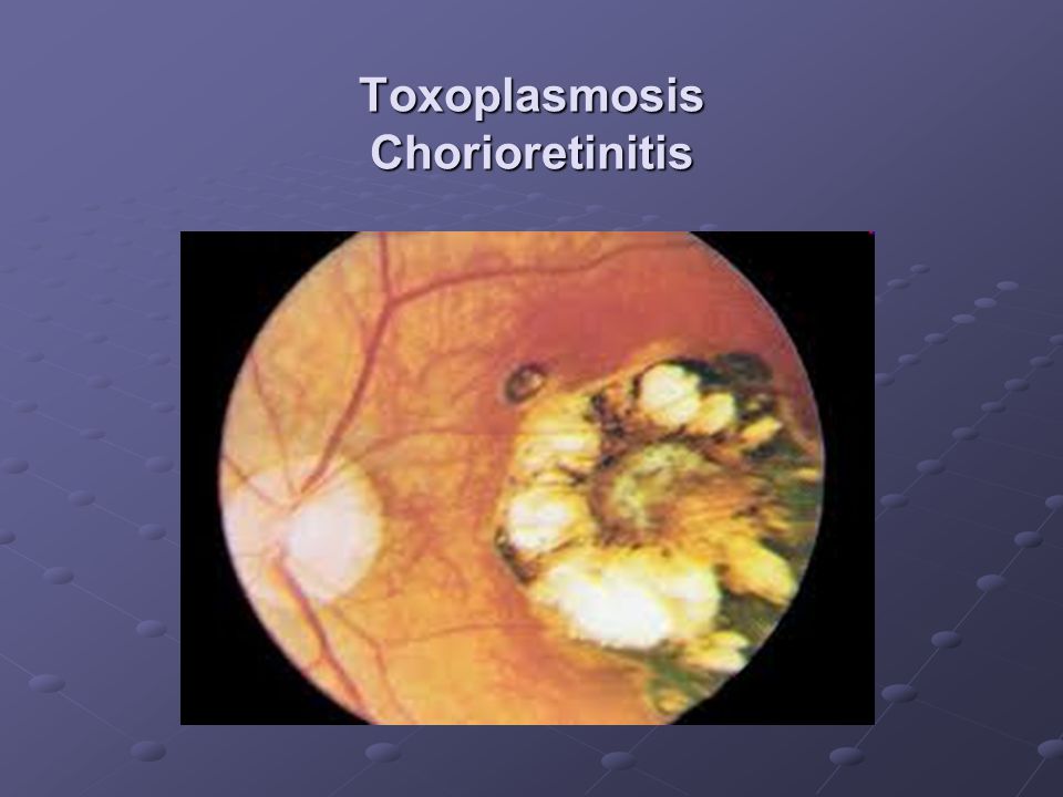 Toxoplasmosis Chorioretinitis