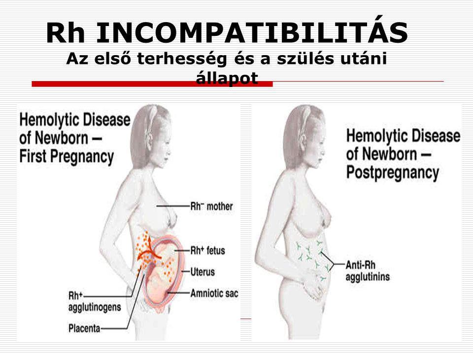 Rh INCOMPATIBILITÁS Az első terhesség és a szülés utáni állapot