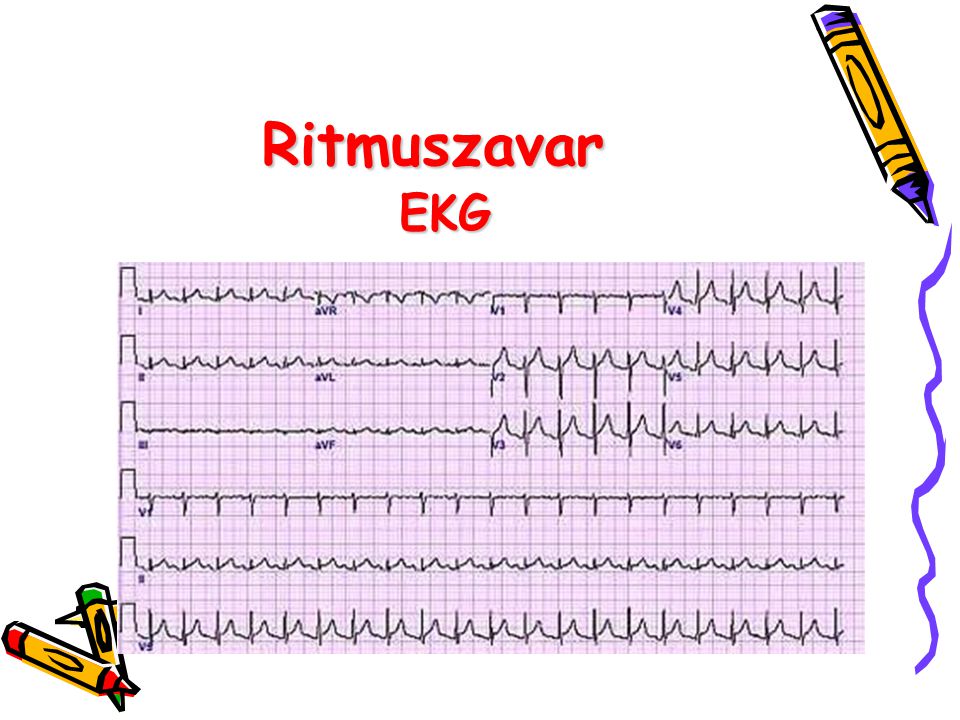 Ritmuszavar EKG