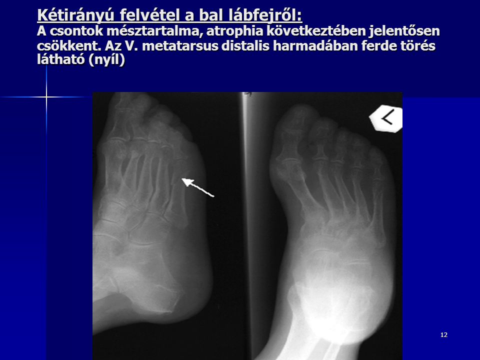 Kétirányú felvétel a bal lábfejről: A csontok mésztartalma, atrophia következtében jelentősen csökkent.