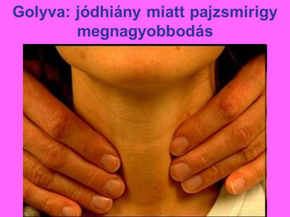 Golyva: jódhiány miatt pajzsmirigy megnagyobbodás