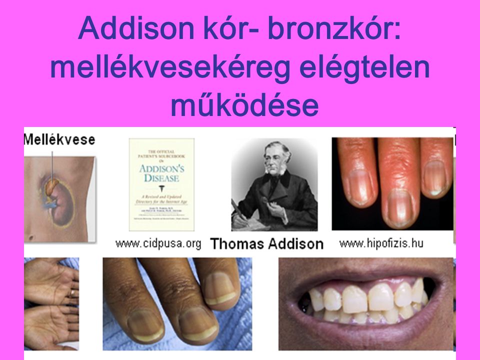 Addison kór- bronzkór: mellékvesekéreg elégtelen működése
