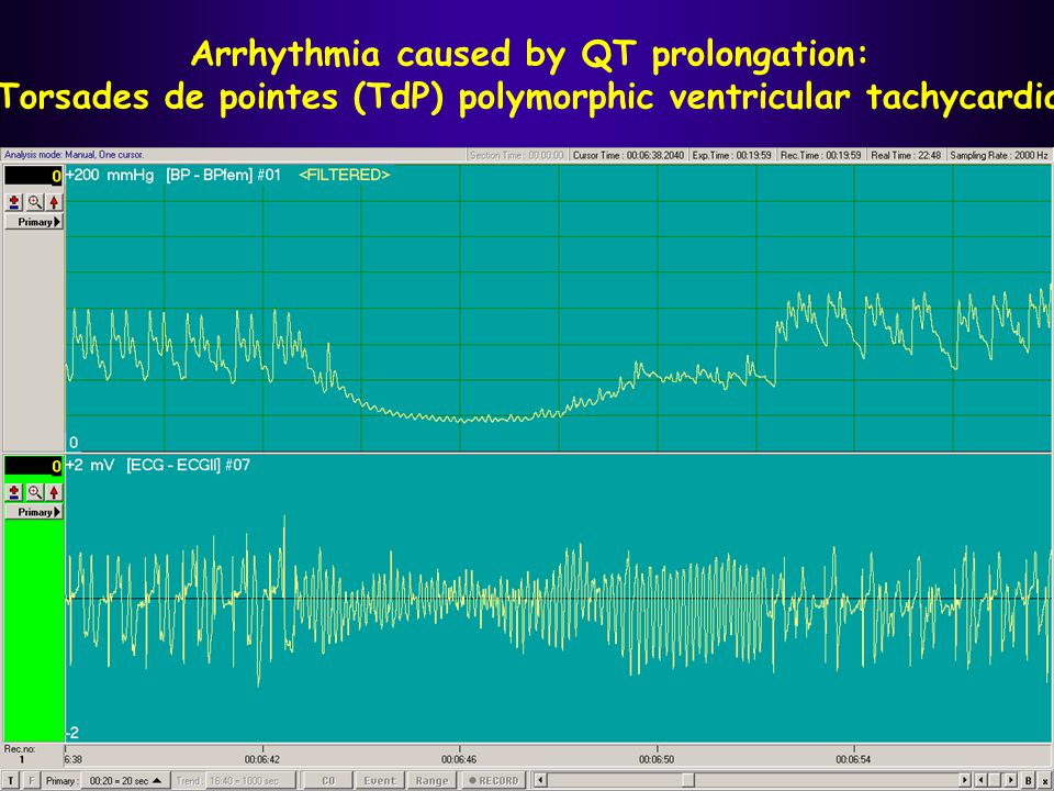 Arrhythmia caused by QT prolongation: