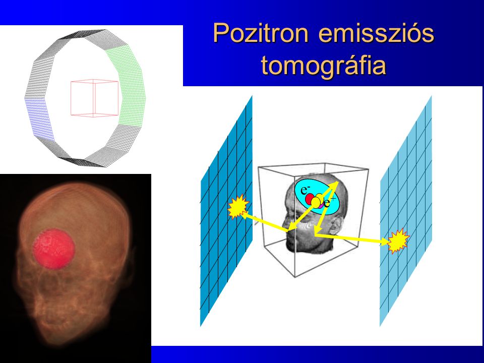 Pozitron emissziós tomográfia