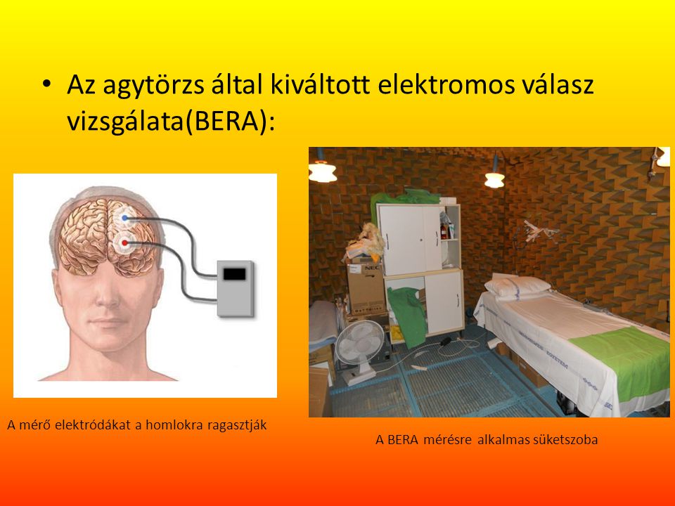 Az agytörzs által kiváltott elektromos válasz vizsgálata(BERA):