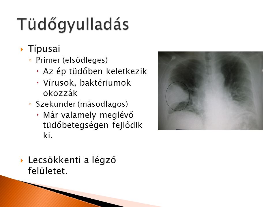Tüdőgyulladás Típusai Lecsökkenti a légző felületet.