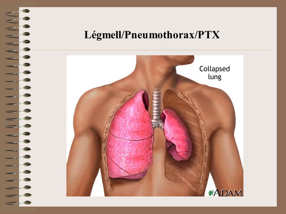 Légmell/Pneumothorax/PTX