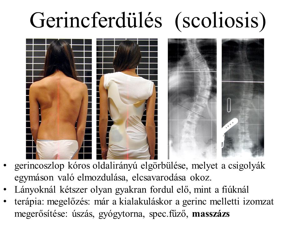 Gerincferdülés (scoliosis)