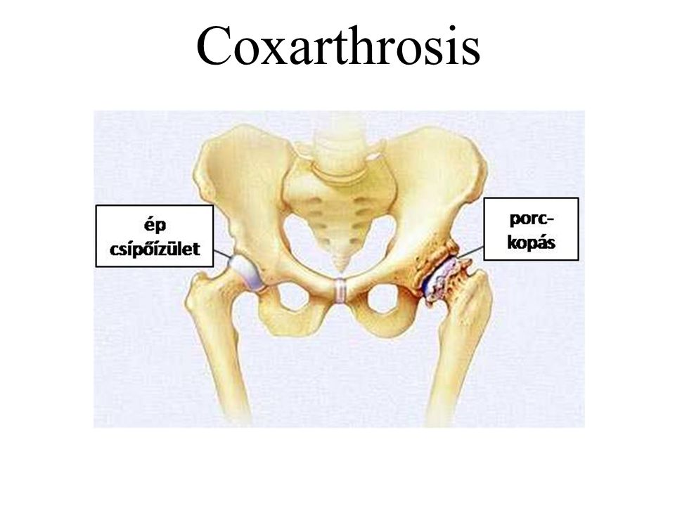 Coxarthrosis