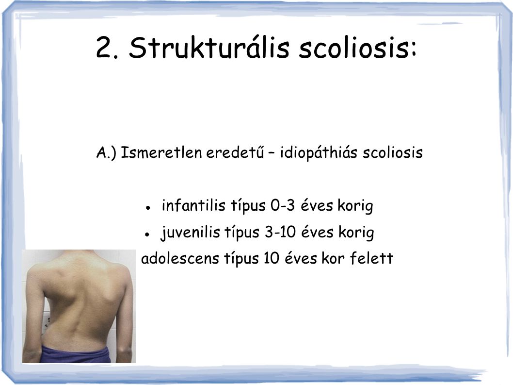 2. Strukturális scoliosis: