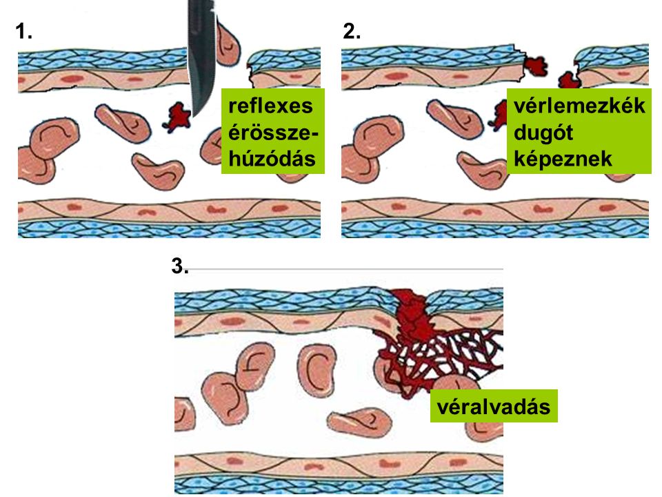 1. 2. reflexes érössze- húzódás vérlemezkék dugót képeznek 3. véralvadás