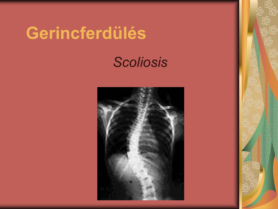 Gerincferdülés Scoliosis