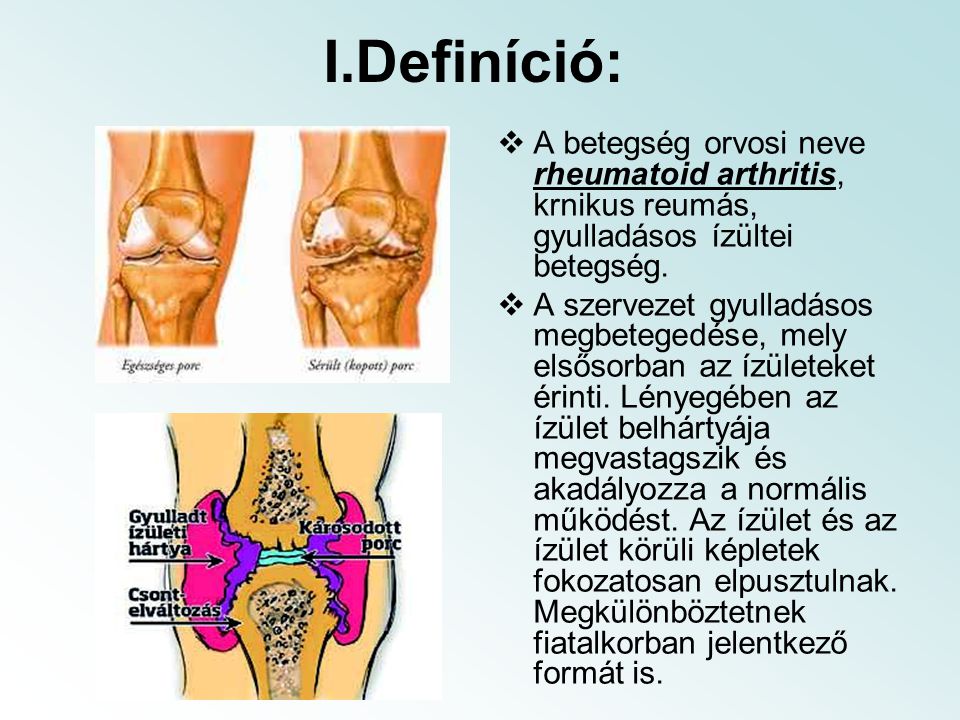 I.Definíció: A betegség orvosi neve rheumatoid arthritis, krnikus reumás, gyulladásos ízültei betegség.