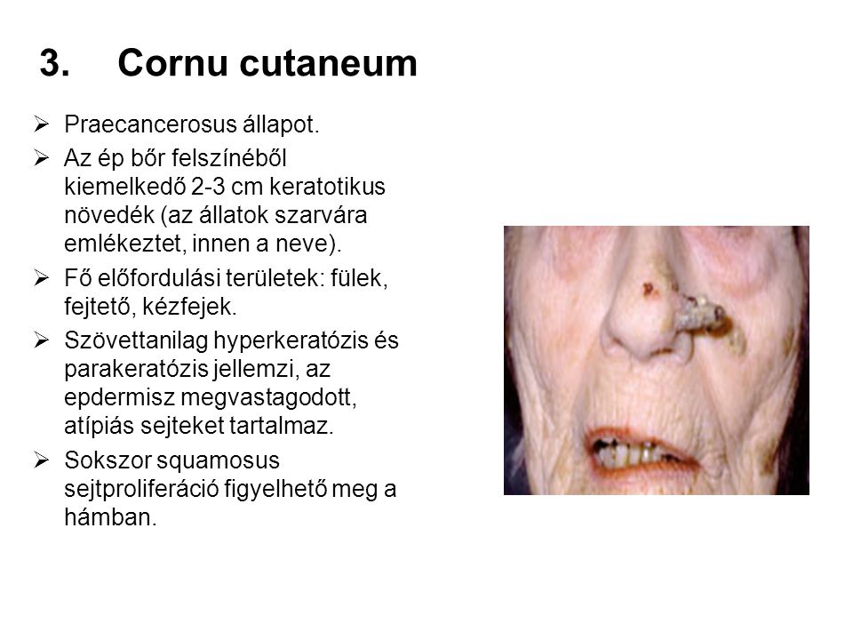 Cornu cutaneum Praecancerosus állapot.
