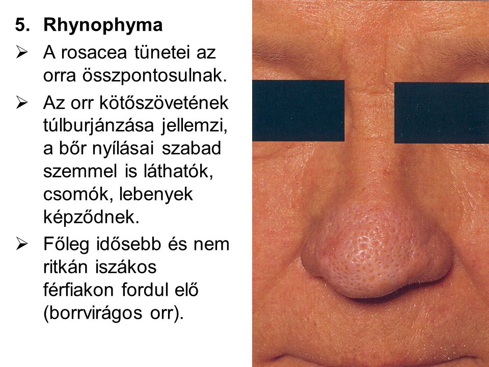 Rhynophyma A rosacea tünetei az orra összpontosulnak.