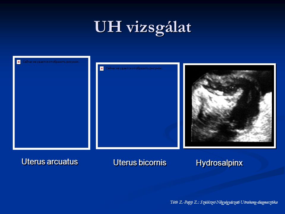 UH vizsgálat Uterus arcuatus Uterus bicornis Hydrosalpinx