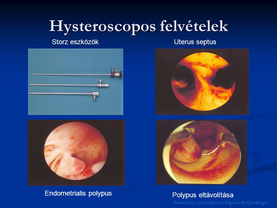 Hysteroscopos felvételek