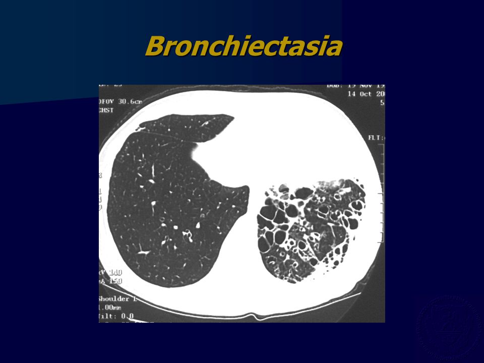 Bronchiectasia