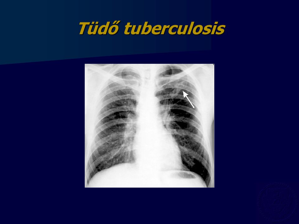 Tüdő tuberculosis