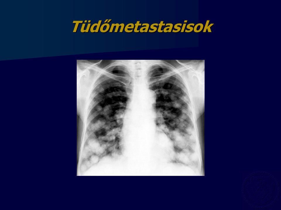 Tüdőmetastasisok