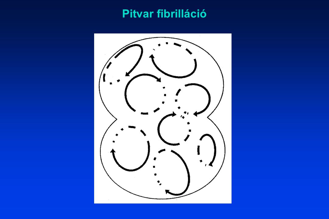 Pitvar fibrilláció
