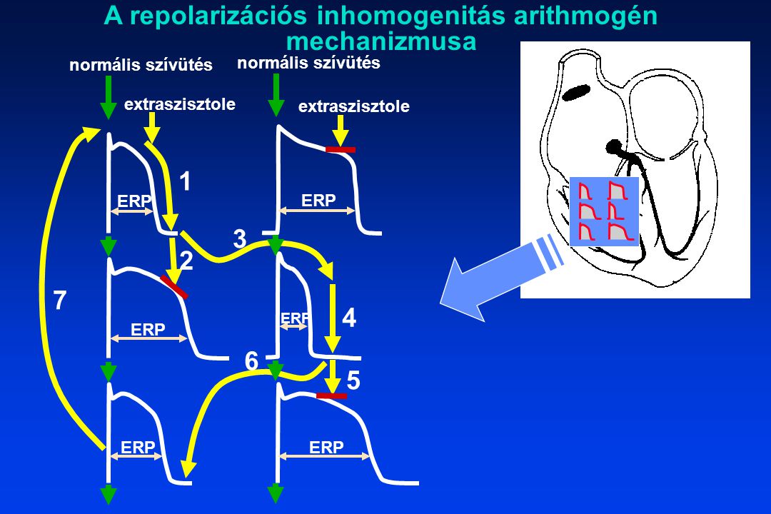 A repolarizációs inhomogenitás arithmogén mechanizmusa