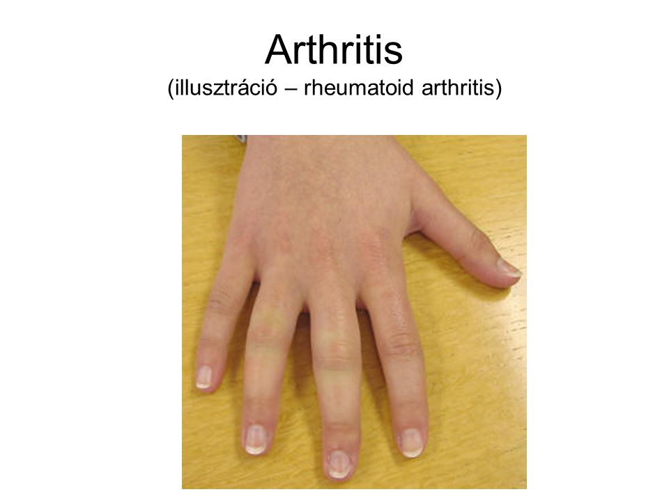 Arthritis (illusztráció – rheumatoid arthritis)