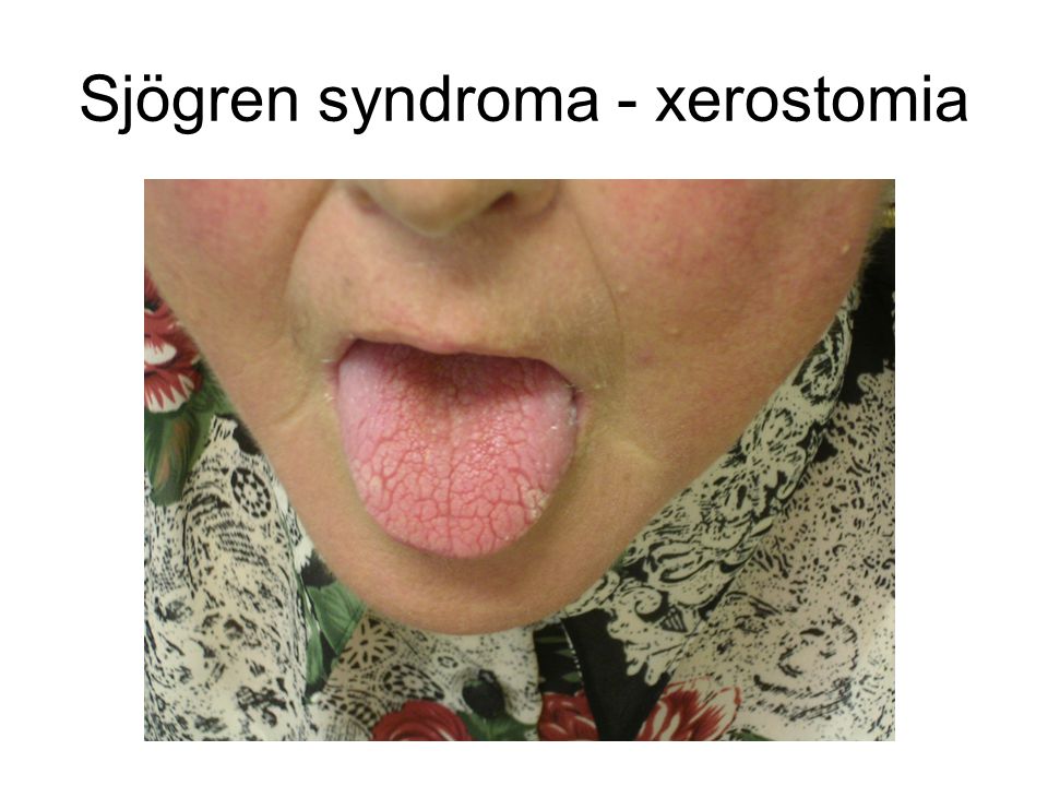 Sjögren syndroma - xerostomia
