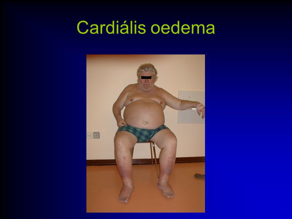 Cardiális oedema