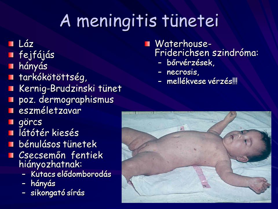 A meningitis tünetei Láz fejfájás hányás tarkókötöttség,