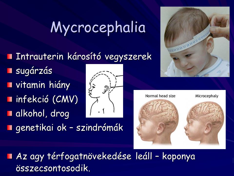 Mycrocephalia Intrauterin károsító vegyszerek sugárzás vitamin hiány