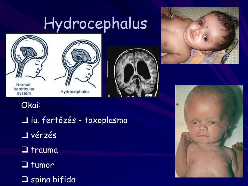 Hydrocephalus Okai: iu. fertőzés - toxoplasma vérzés trauma tumor
