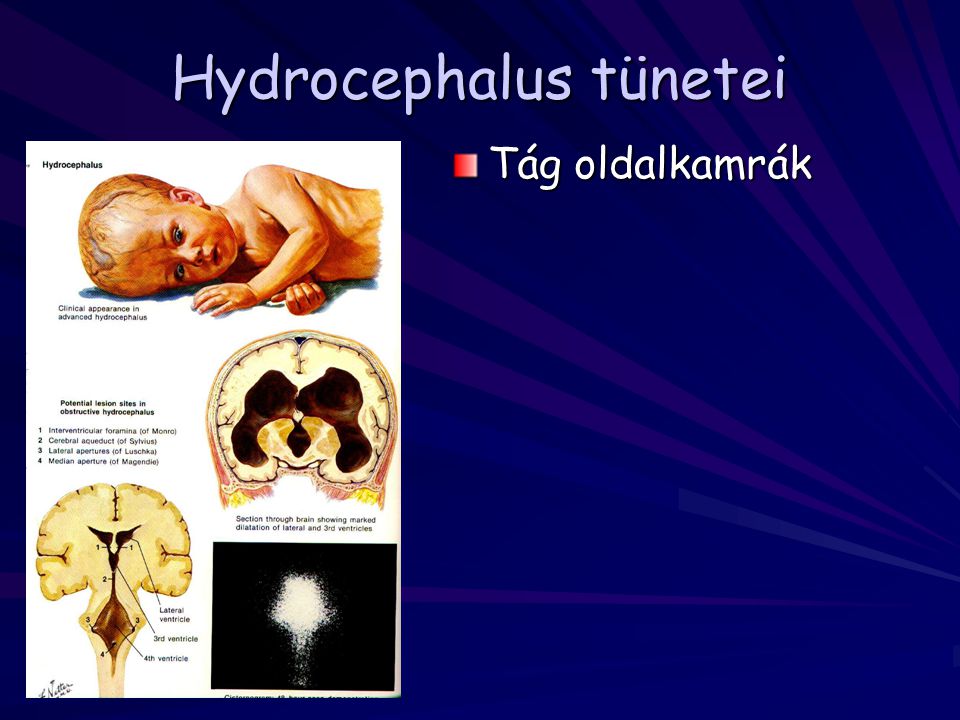 Hydrocephalus tünetei