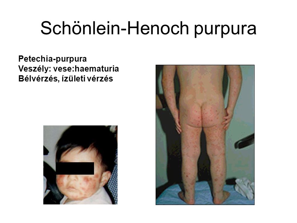 Schönlein-Henoch purpura